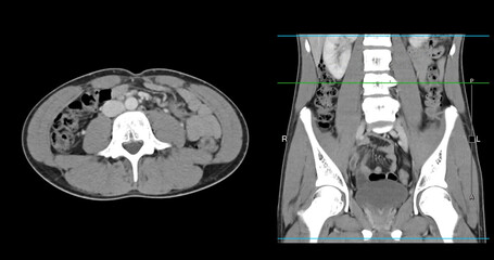  High-resolution CT scan Lower abdomen showing a normal lower abdomen for diagnostic reference,and healthcare presentations.Clear anatomical highlight healthy abdominal structure.