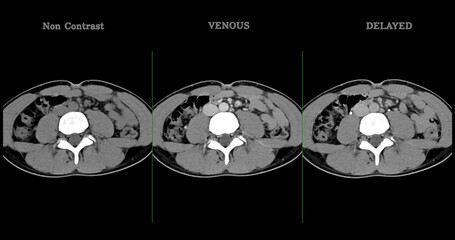  High-resolution CT scan Lower abdomen showing a normal lower abdomen for diagnostic reference,and healthcare presentations.Clear anatomical highlight healthy abdominal structure.
