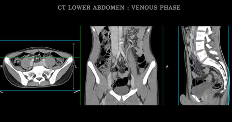  High-resolution CT scan Lower abdomen showing a normal lower abdomen for diagnostic reference,and healthcare presentations.Clear anatomical highlight healthy abdominal structure.
