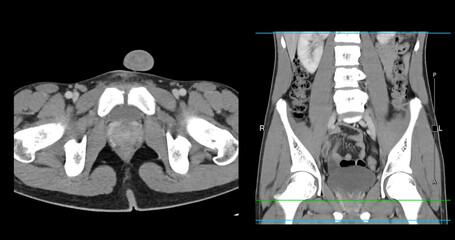  High-resolution CT scan Lower abdomen showing a normal lower abdomen for diagnostic reference,and healthcare presentations.Clear anatomical highlight healthy abdominal structure.