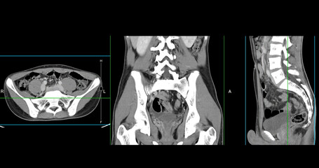  High-resolution CT scan Lower abdomen showing a normal lower abdomen for diagnostic reference,and healthcare presentations.Clear anatomical highlight healthy abdominal structure.