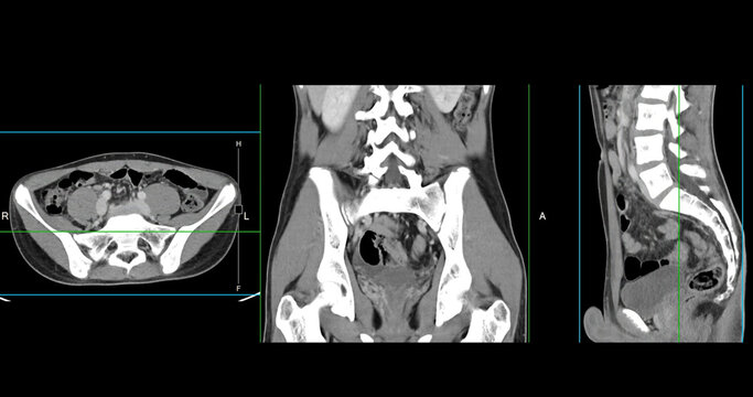  High-resolution CT scan Lower abdomen showing a normal lower abdomen for diagnostic reference,and healthcare presentations.Clear anatomical highlight healthy abdominal structure.