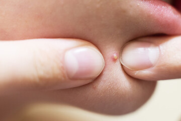 Fingers squeezing a whitehead pimple on skin