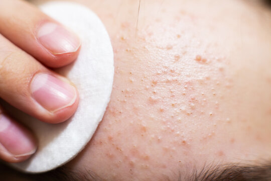 Forehead skin cleansing with cotton pad removing acne