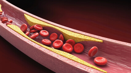 Atherosclerosis with cholesterol blood or plaque in vessel cause of coronary artery disease