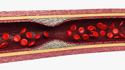 Atherosclerosis with cholesterol blood or plaque in vessel cause of coronary artery disease