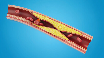 Atherosclerosis with cholesterol blood or plaque in vessel cause of coronary artery disease