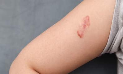 Selective focus A raised scar after a wound has healed on the skin. In the medical world it is called a keloid which is caused by excess protein (collagen) in the skin during the healing period. 