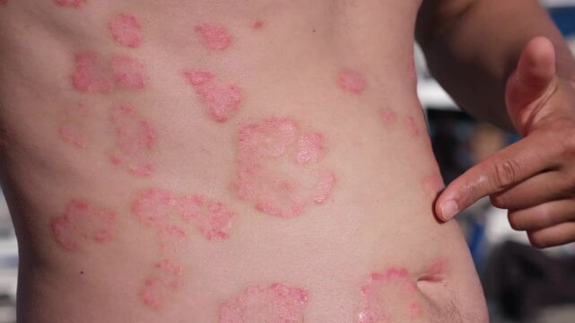 Individual shows unique skin markings on torso while enjoying activities outside in warm weather. Natural curiosity arises around their appearance.
