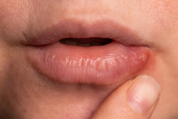 Close-up view shows a lip herpes virus lesion on the mucous membrane of the skin. Emphasis on...