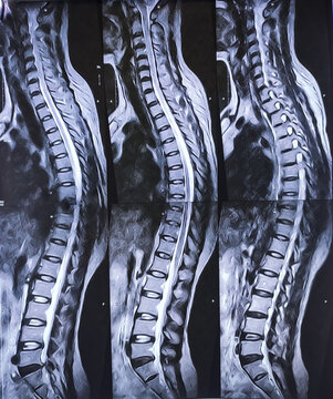 MRI scan of lambo-sacaral spine (LS-spine) : Central and left paracentral extrusion. Nerve root compression with spinal canal stenosis. Medical image concept.