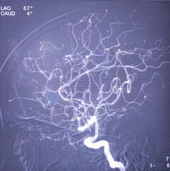 Digital Subtraction Angiography (DSA) or Cerebral angiography of brain, a technique used to visualize blood vessels in the brain during procedures like angioplasty and stenting. Digital arteriogram.