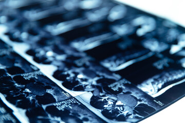 Detailed mri scan of spinal protrusion