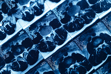 Detailed mri scan of adult man spine highlighting disc protrusion