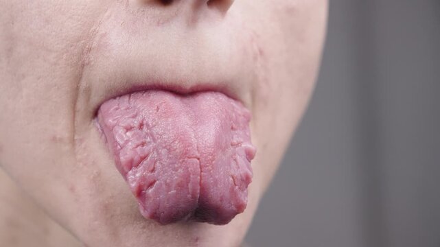 Woman showing geographic tongue, migratory glossitis  to doctor in blue gloves
