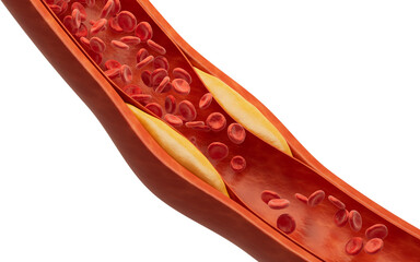 Blood vessel with blood fat in it, 3d rendering.