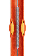 Blood vessel with coronary stent in it, 3d rendering.