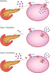 Cellular Mechanisms of Healthy, Type 1, and Type 2 Diabetes Vector Illustration