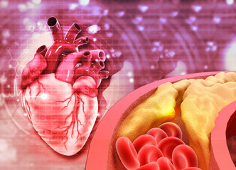 Human heart with Blocked blood vessel, cholesterol blocking artery. 3d illustration