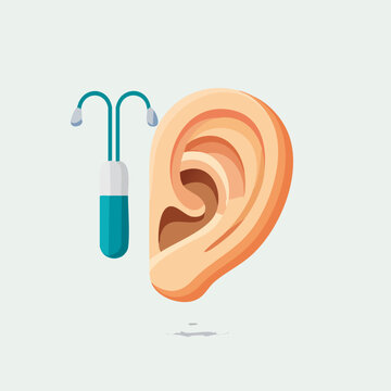 Cochlear Implant Illustration - Hearing Aid Technology and Ear Anatomy.