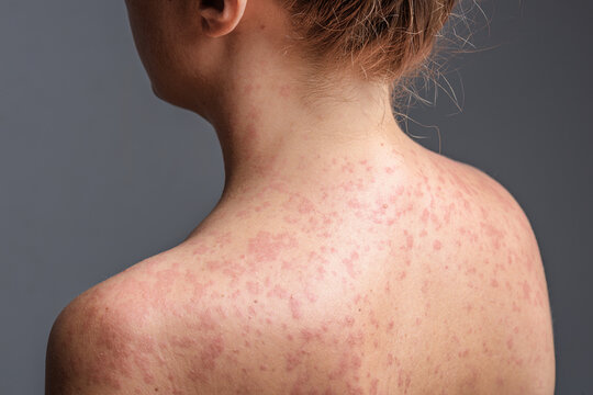 A woman with a red, spotty rash caused by measles.