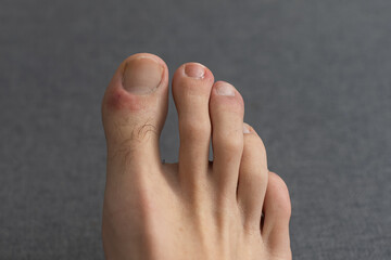 The foot, five toes, of a caucasian male with a damaged toe. Underneath the nail. small round...