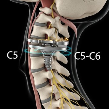 Cervical spine disc replacement surgery anatomy medical illustration