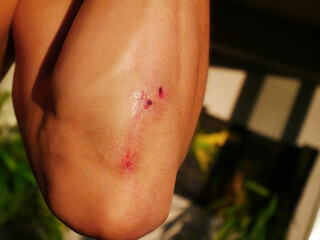 Fototapeta premium Injured man Elbow with Scrapes Against Blurred Background