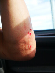 Injured man Elbow with Scrapes Against Blurred Background