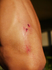 Fototapeta premium Injured man Elbow with Scrapes Against Blurred Background