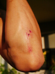 Fototapeta premium Injured man Elbow with Scrapes Against Blurred Background
