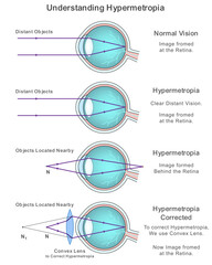 Labeled Diagram Explaining Eye Defect Hypermetropia and Its Image Formation