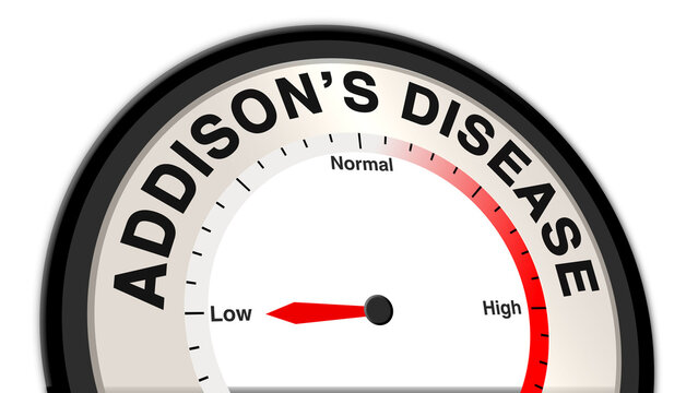 Addison&rsquo;s disease at low severity, displayed on a barometer or tachometer, indicating stable adrenal function with minimal symptoms, reflecting effective management and control
