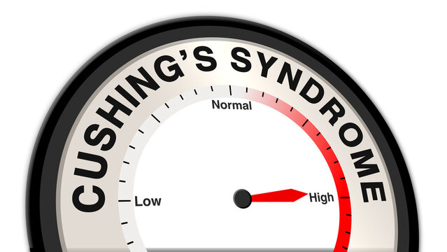 Cushing's syndrome at high severity displayed on a barometer or tachometer, showing severe symptoms like rapid weight gain, high blood pressure, and fatigue, requiring urgent medical care