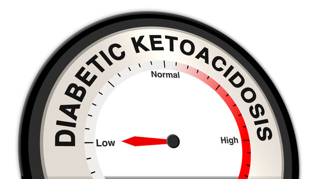 Diabetic ketoacidosis at low severity displayed on a barometer or tachometer, reflecting mild symptoms like increased thirst, slight fatigue, and elevated blood sugar, with focus on early intervention