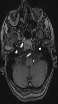 Axial MRI Scan of Human Brain &ndash; Black and White Neuroimaging