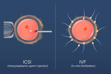 In Vitro Fertilization-IVF and Intracytoplasmic sperm injection-ICSI. Fertility treatment. Assisted reproductive technology in fertility treatment.