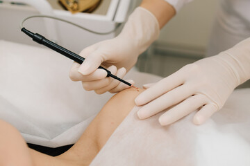 Dermatologist performs precise radio wave mole removal using radiofrequency surgery. Close-up of radio wave dermatologic mole excision. Radiofrequency mole removal under clinical conditions.