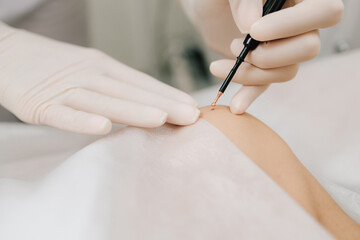 Dermatologist performs precise radio wave mole removal using radiofrequency surgery. Close-up of radio wave dermatologic mole excision. Radiofrequency mole removal under clinical conditions.