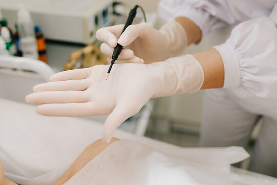 Radiofrequency mole removal under clinical conditions. dermatologist performs precise radio wave mole removal using radiofrequency surgery. Close-up of radio wave dermatologic mole excision.