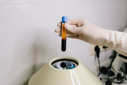 PRP process separates platelet-rich plasma for advanced regenerative mesotherapy applications. PRP preparation involves centrifuging blood to isolate plasma rich in platelets for medical mesotherapy.