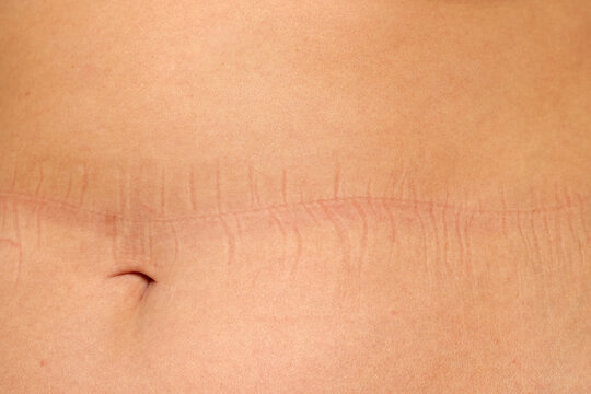Fototapeta Studio shot of overweight woman stomach with elastic marks from underwear on white background.