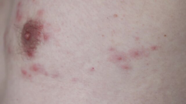 Clinical observational video showing the progression of a Shingles (Herpes Zoster) rash over several days. The video captures the onset of inflammation, the formation of fluid-filled.