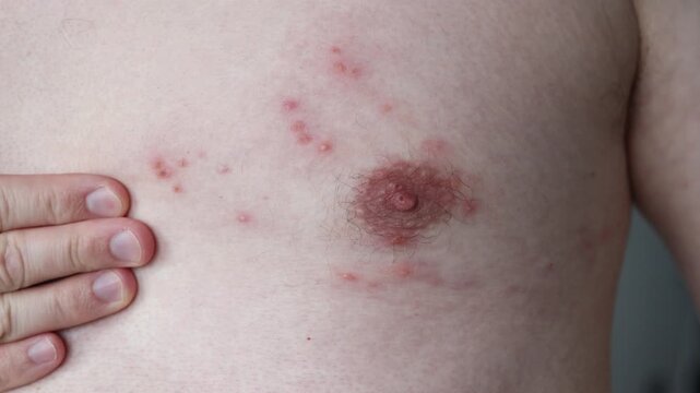  High-resolution video footage illustrating the localized, painful presentation of Herpes Zoster (Shingles), focusing on the progression of fluid-filled blisters along a specific nerve pathway.