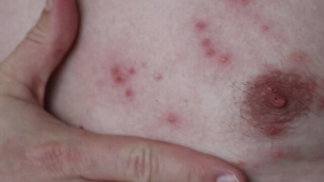 Close-up image showing the skin rash and blisters typical of Shingles Herpes Zoster. Used for medical education, dermatology reference, and awareness of viral skin infections.