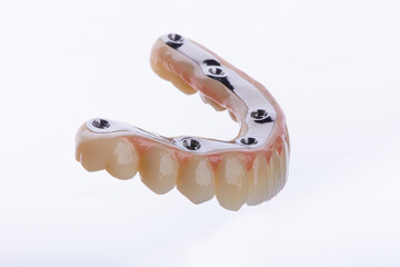 Full dental zirconium prosthesis on titanium bar stained with stains for ceramic.
