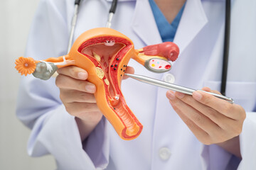 Uterus, doctor holding human anatomy model for study diagnosis and treatment in hospital.
