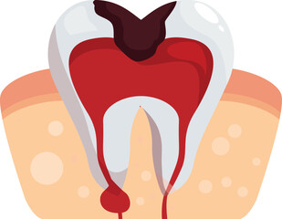 Diseased tooth with caries and gingivitis bleeding and causing periodontitis, requiring urgent dental care
