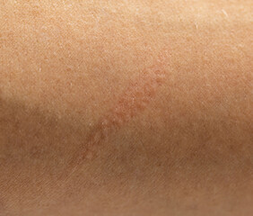 Fototapeta premium A person's arm with a scar