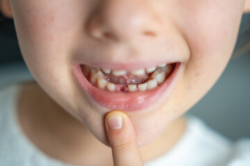 Fototapeta premium Close-up of child smiling mouth with missing baby tooth and pointing finger. A proud moment of growing up and celebrating childhood milestones.